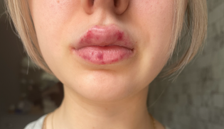  Swelling and bruising of lips after lip procedure