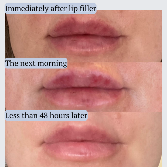 11 units of AfterMED Lips