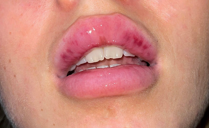  Moderate lip swelling after lip filler 