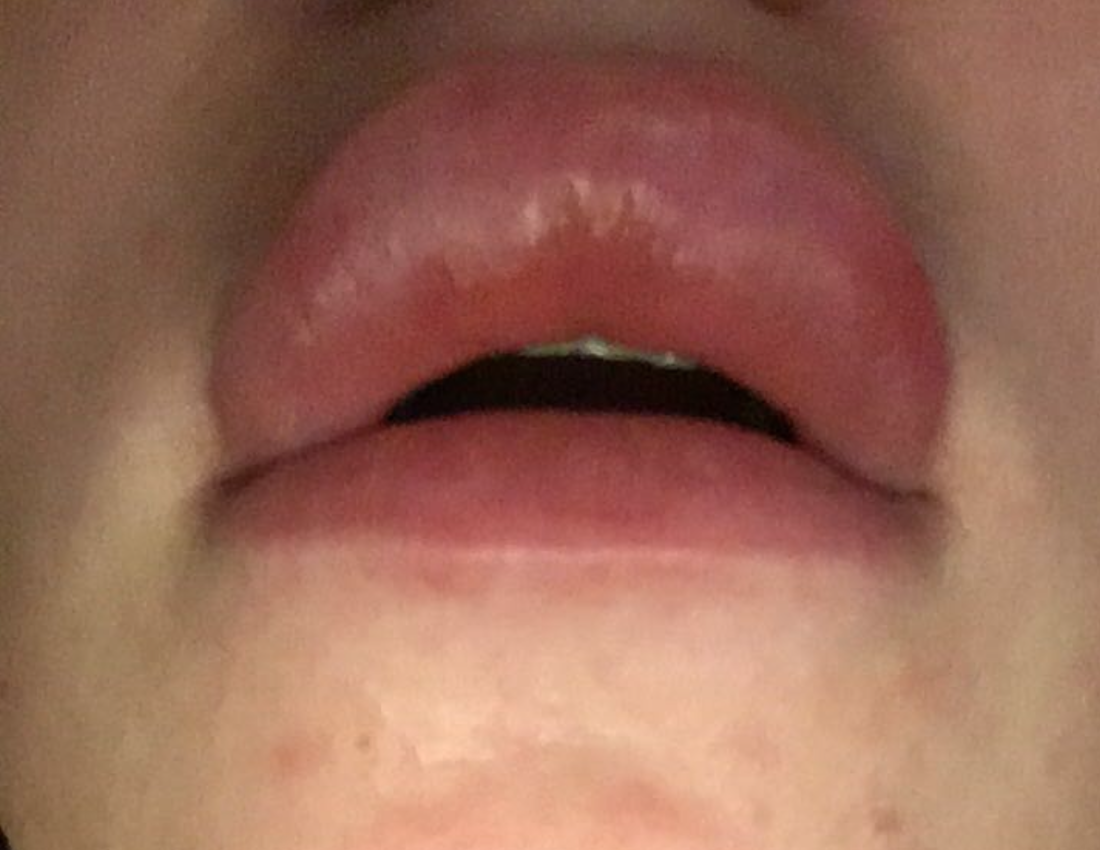  Swelling on lips after lip filler treatment 