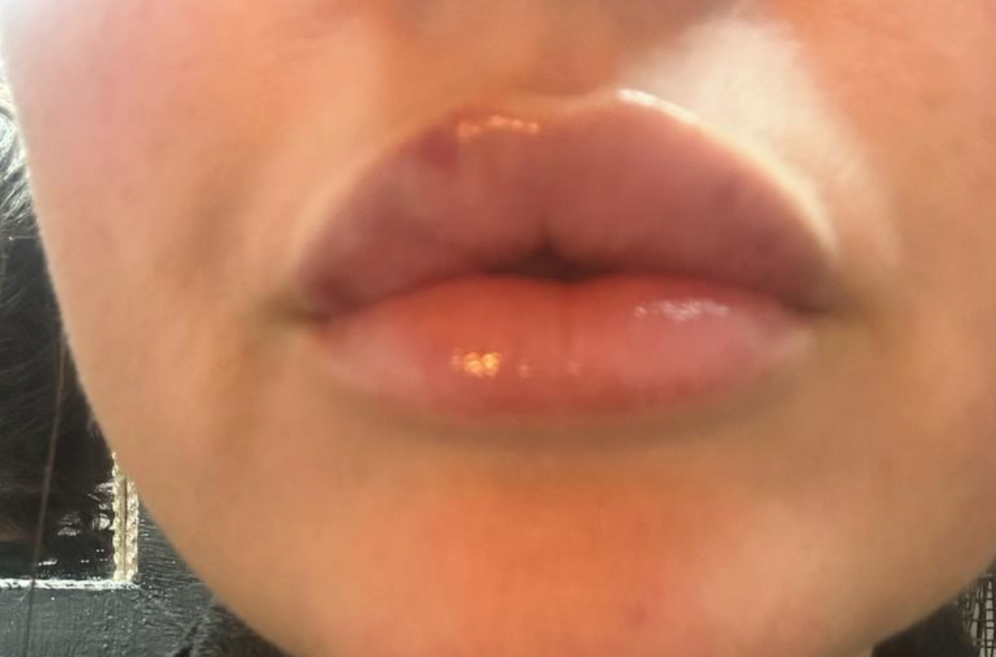  Mild swelling on lips after lip filler treatment