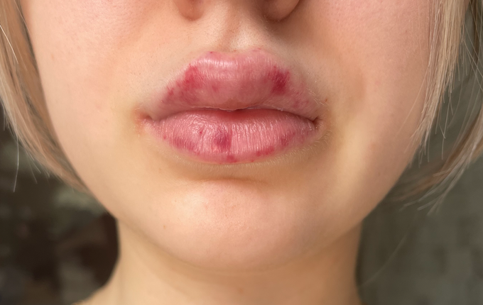  Moderate swelling of the lips after lip injections